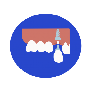 dental implants houston | Dental Implant Clinic In Houston TX