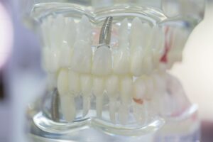 how much is a single tooth implant