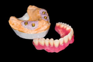 all on 4 dental implants | All On Four Dental Implants In Houston
