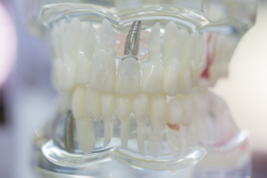 Best Dental Implants | Single Tooth Implant in Houston TX