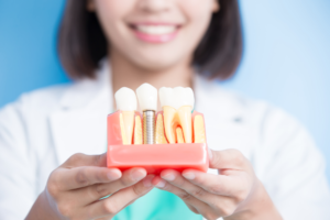 dental implants cost