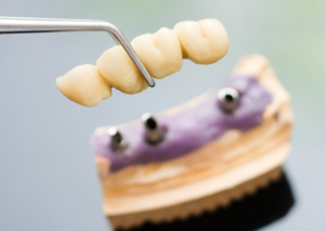 tooth implant